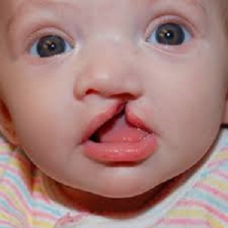 Cleft Lip