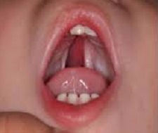 Cleft Palate