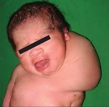 Cystic Hygroma (Lymhangioma)