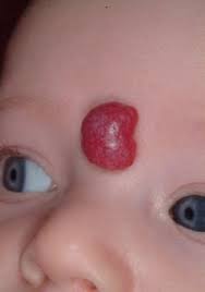 Hemangioma of Face