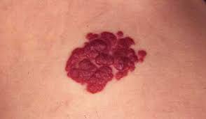 Hemangioma