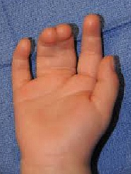Syndactyly