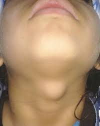 Thyroglossal Cyst